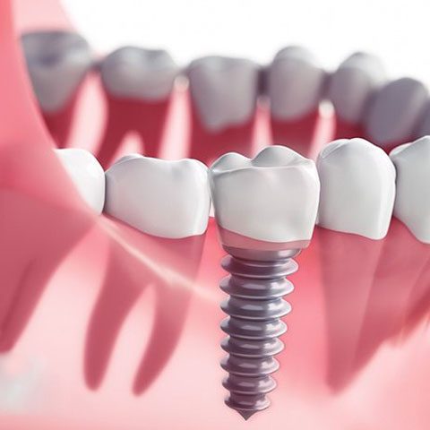 Dental-implants