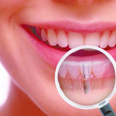 Saving-My-Dental-Implants